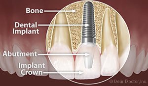 Dental Implants | Dentist In Sun City, AZ | Grand Dental